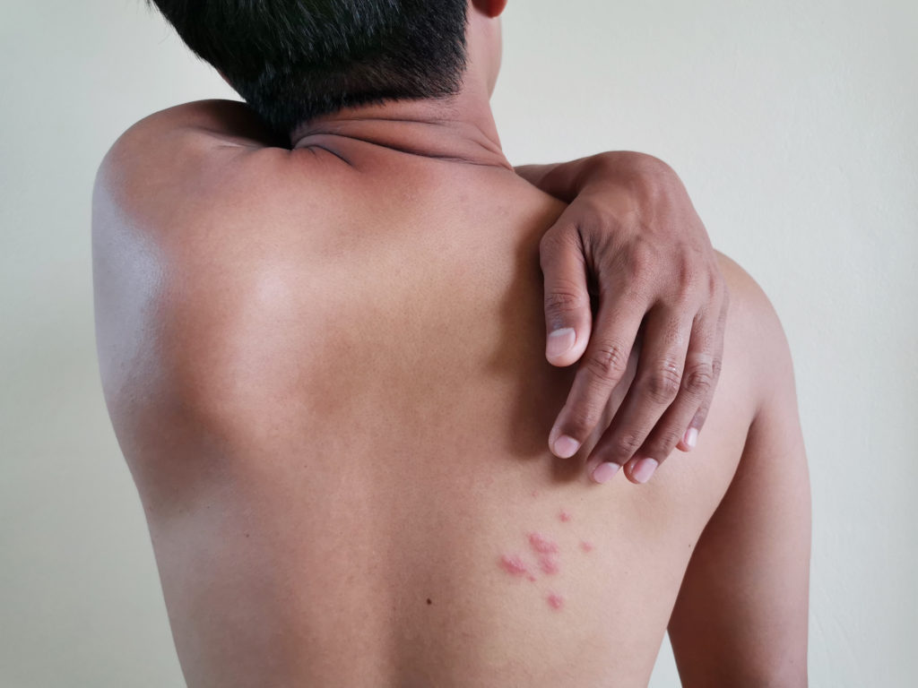 medical marijuana and shingles